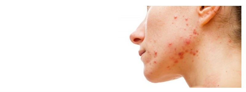 acne vulgaris affecting the left cheek and jaw