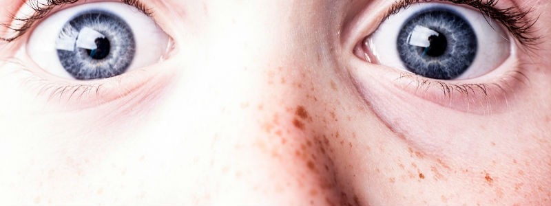 ephelides-freckles-nose-conditions 
