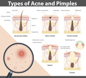 Development of spots in acne: blackheads, whiteheads, papules and pustules