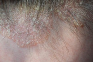 psoriatic patch on scalp