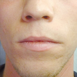 plexr-acne-after-treatments-harley-street-emporium