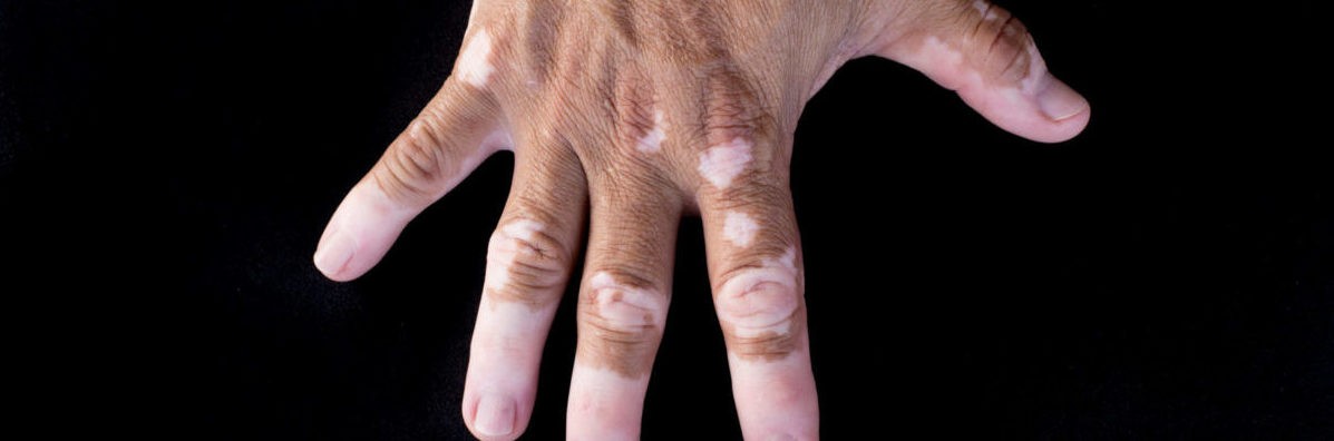 vitiligo-darker-skin-problems-journal-harley-street-emporium