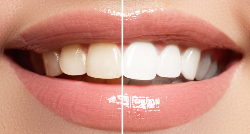 teeth-whitening-journal-harley-street-emporium