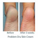 neostrata-before-and-after-cracked-heels-problem-dry-skin-cream-shop-harley-street-emporium
