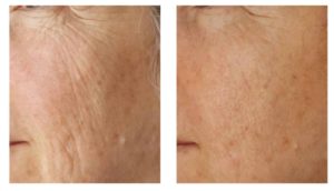 tixel-before-and-after-1-treatments-harley-street-emporium