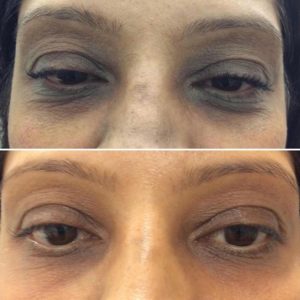 Dr-Unnati-Desai-pigmentation-eye-treatment-harley-street-emporium
