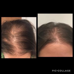 AQ-solutions-Hair-loss-before-and-after-journal-harley-street-emporium