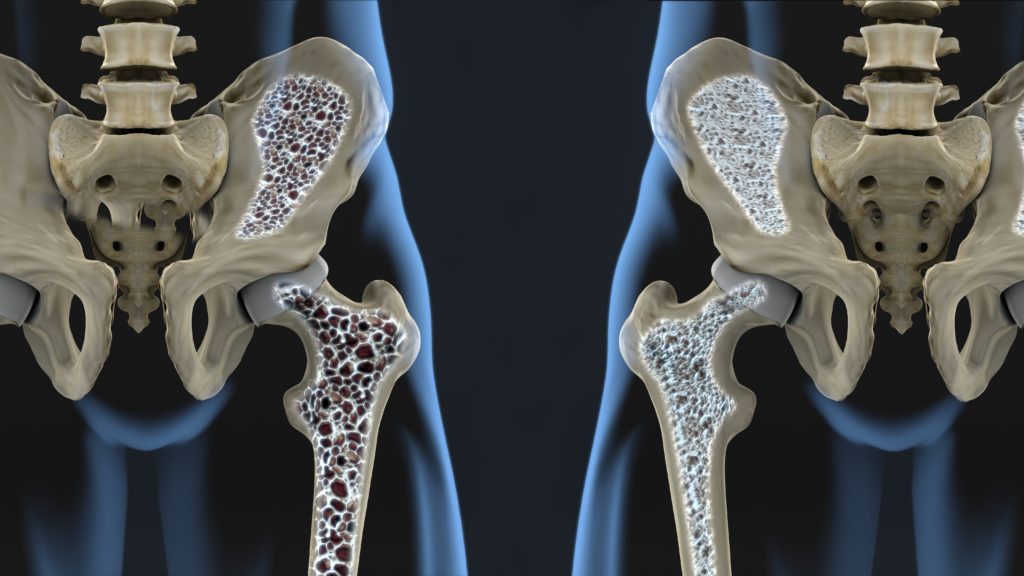 osteoporosis-harley-street-emporium