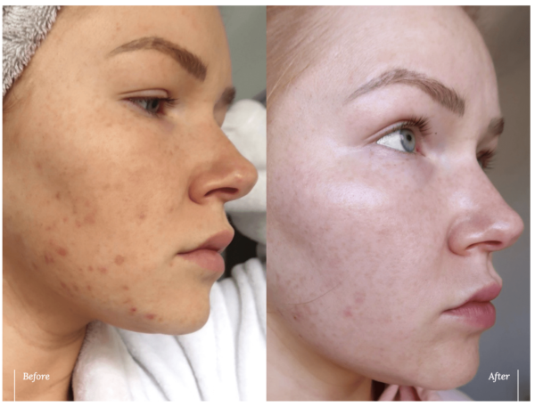 ESK hydroxy overnight mask before and after