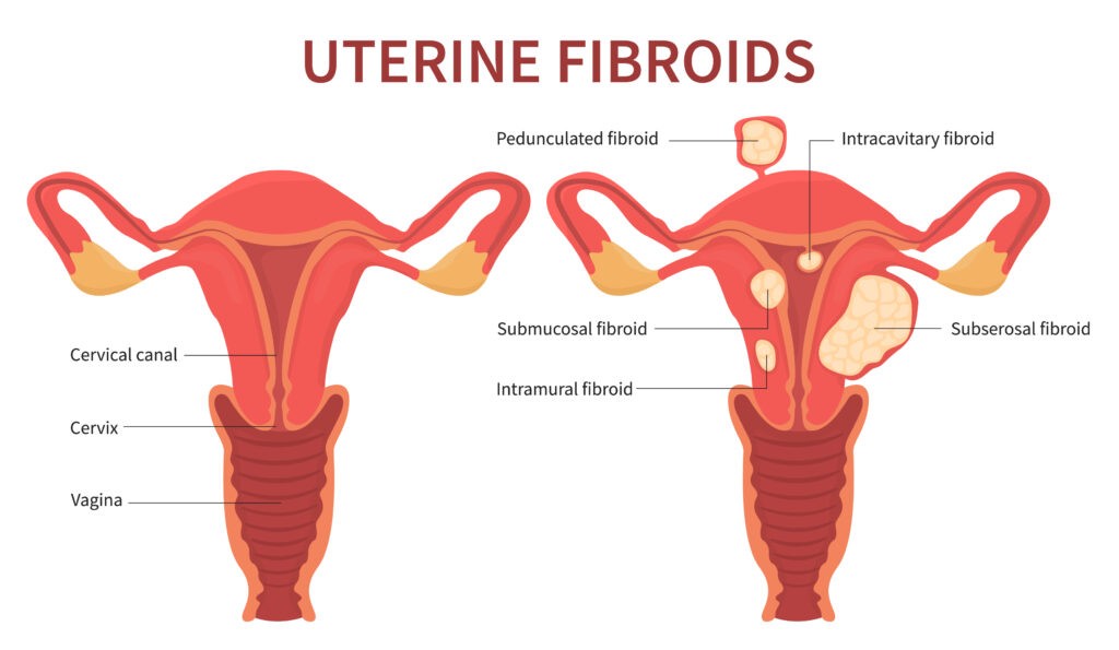 uterine fibroids, menopause the messy bits, harley street emporium