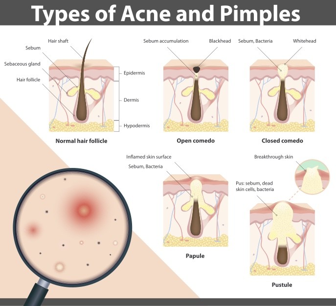 what is evolutionary purpose of acne