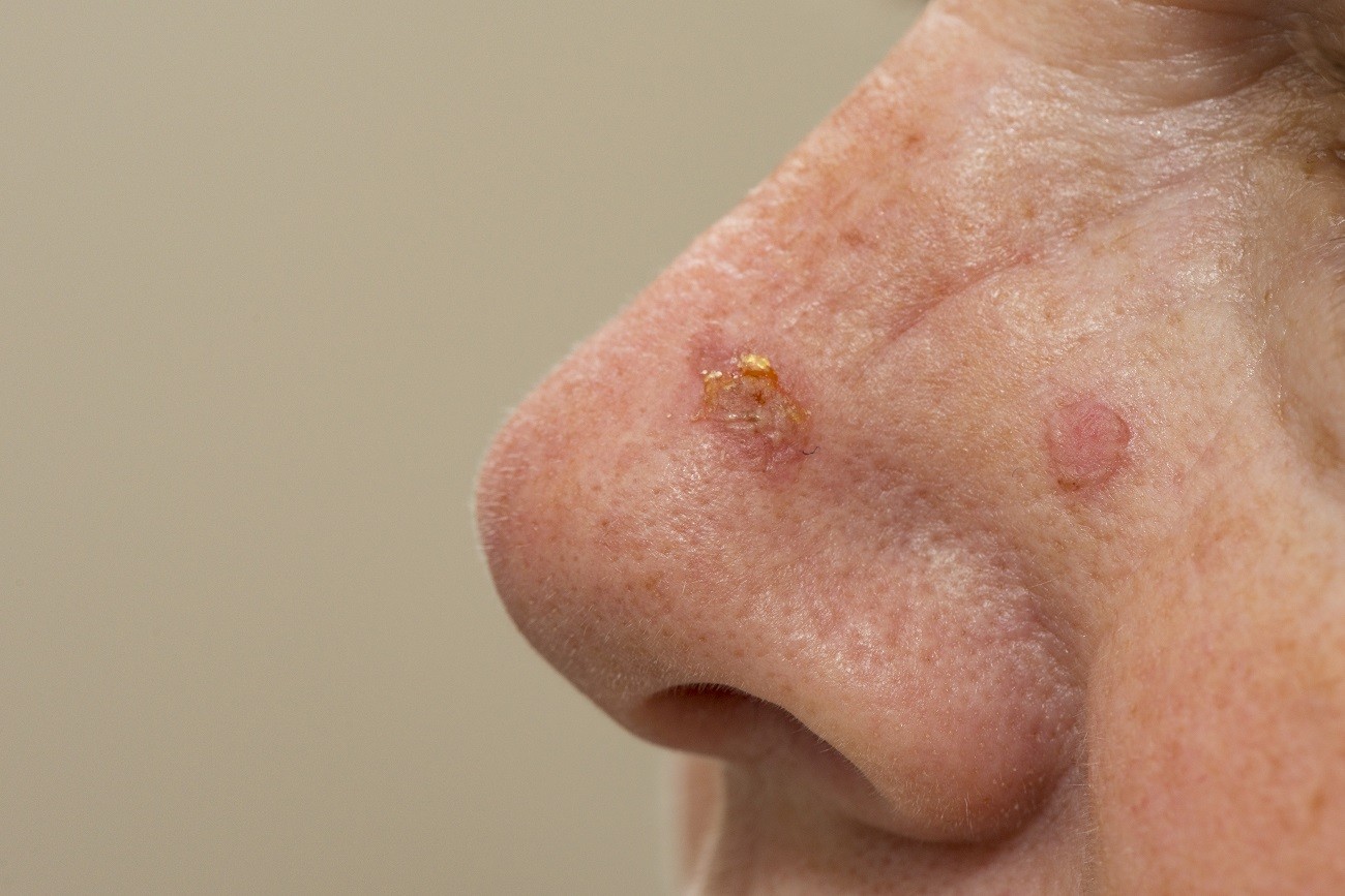 solar keratoses on tip of nose