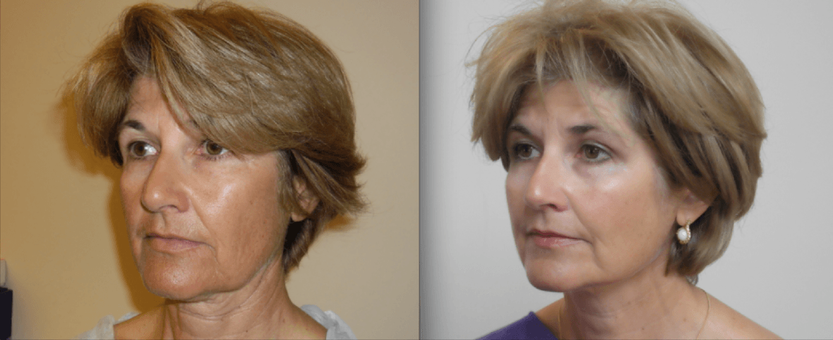 silhouette-before-and-after-treatments-harley-street-emporium