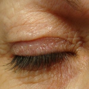 eye-plexr-before-treatments-harley-street-emporium