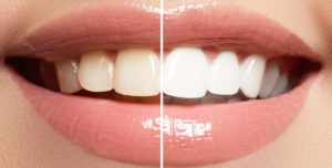 tooth-whitening-journal-harley-street-emporium