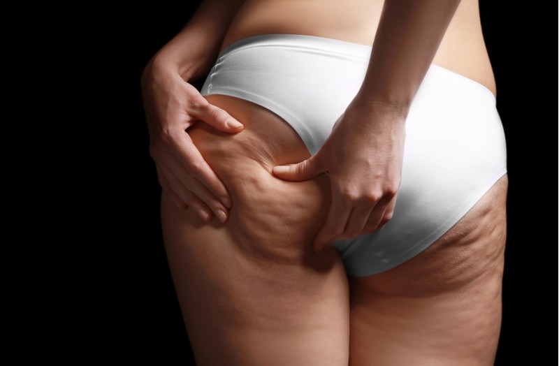 How to get rid of cellulite: what works and what doesn’t