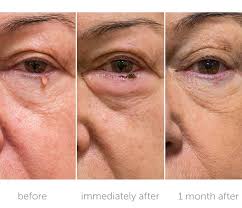 Before-and-after-skin-tag-removal-Jett-Plasma-treatments-harley-street-emporium