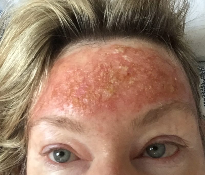 Photo Dynamic Therapy and Actinic Keratosis