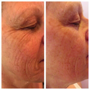 Tixel-before-and -after-2-treatments-harley-street-emporium