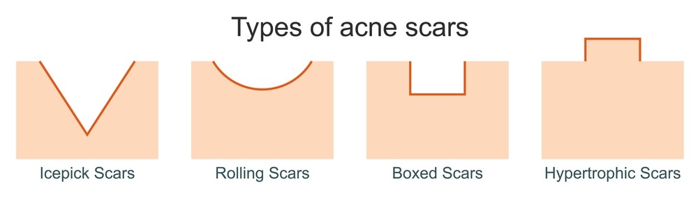 What is subcision treatment for acne